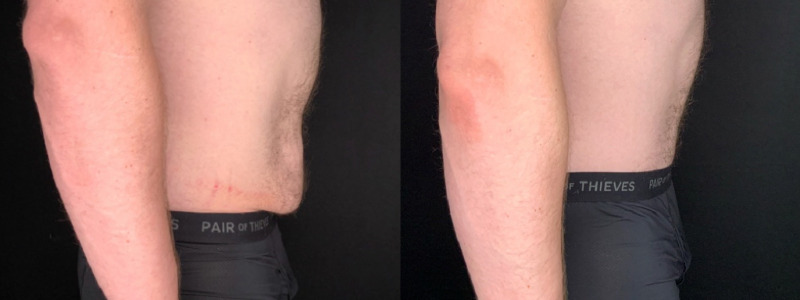 Patient #41269: Tummy Tuck with Liposuction Combine Image