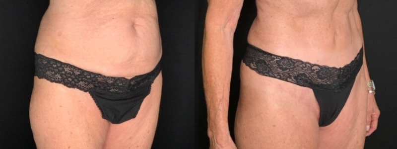 Patient #12479: Tummy Tuck with Liposuction to Flanks Combine Image
