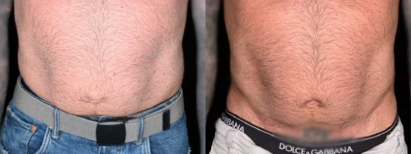 Patient #98547: Liposuction and Hernia Repair Combine Image