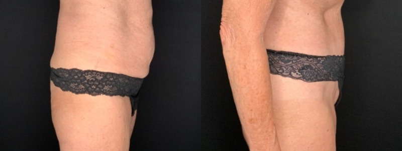 Patient #12479: Tummy Tuck with Liposuction to Flanks Combine Image