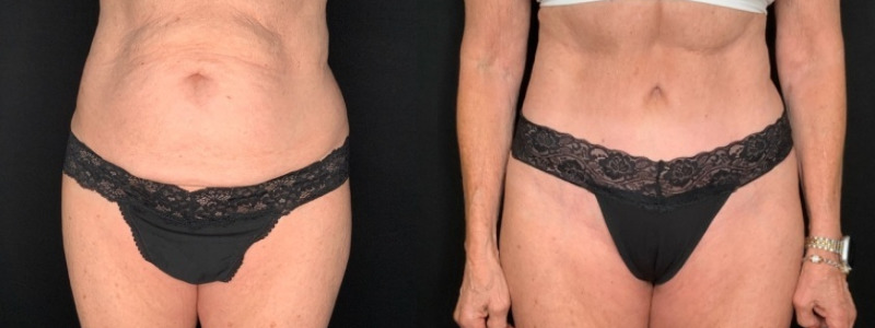 Patient #12479: Tummy Tuck with Liposuction to Flanks Combine Image