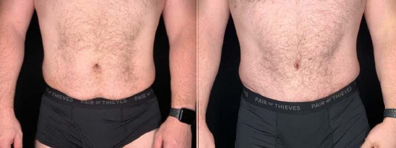 Patient #41269: Tummy Tuck with Liposuction Combine Image