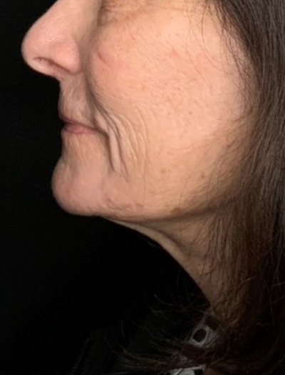 Patient #31258: In-Office Facelift with Fat Injections and Perioral Ablative Laser After Image