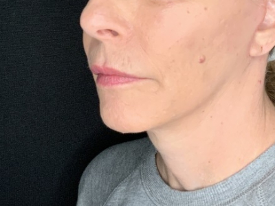 Patient #36789: In-Office Facelift with Fat Injections After Image