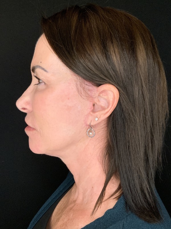 Patient #12585: In-Office Facelift with Fat Injections, Lip Lift, & Perioral Ablative Laser [DUPLICATE] After Image