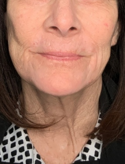 Patient #31258: In-Office Facelift with Fat Injections and Perioral Ablative Laser After Image