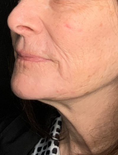 Patient #31258: In-Office Facelift with Fat Injections and Perioral Ablative Laser After Image