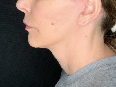 Patient #36789: In-Office Facelift with Fat Injections After Image
