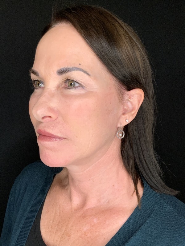 Patient #12585: In-Office Facelift with Fat Injections, Lip Lift, & Perioral Ablative Laser [DUPLICATE] After Image