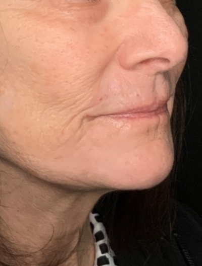 Patient #31258: In-Office Facelift with Fat Injections and Perioral Ablative Laser After Image
