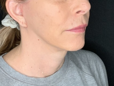 Patient #36789: In-Office Facelift with Fat Injections After Image