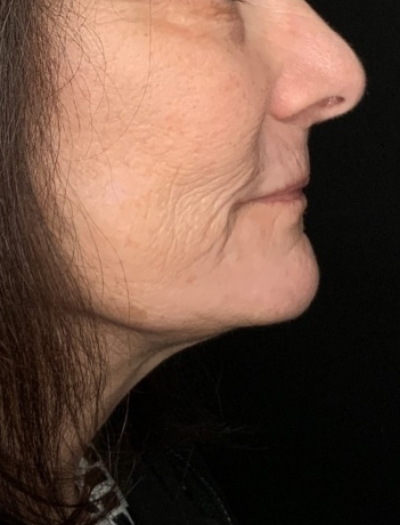 Patient #31258: In-Office Facelift with Fat Injections and Perioral Ablative Laser After Image