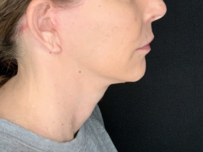 Patient #36789: In-Office Facelift with Fat Injections After Image