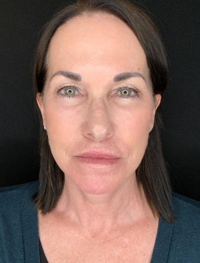 Patient #12585: In-office facelift with Fat Injections, Lip Lift & Perioral Ablative Laser After Image