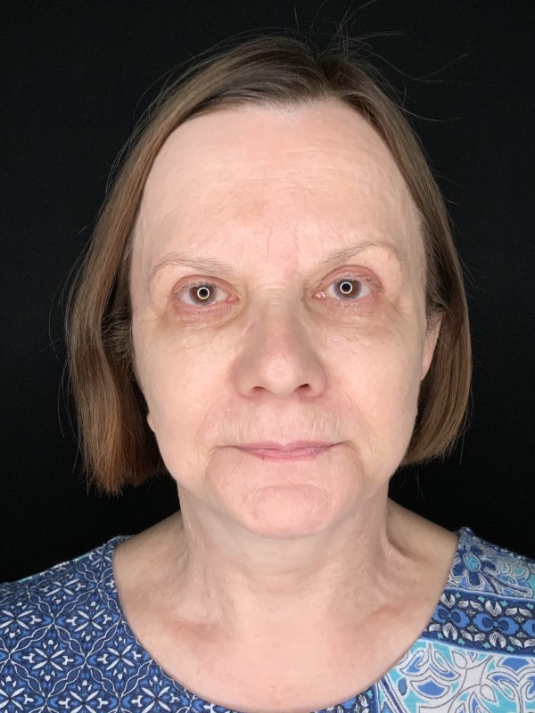 Patient #36954: In-Office Facelift with Fat Injections and Upper Blepharoplasty After Image