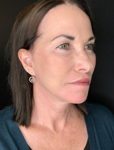 Patient #12585: In-office facelift with Fat Injections, Lip Lift & Perioral Ablative Laser After Image