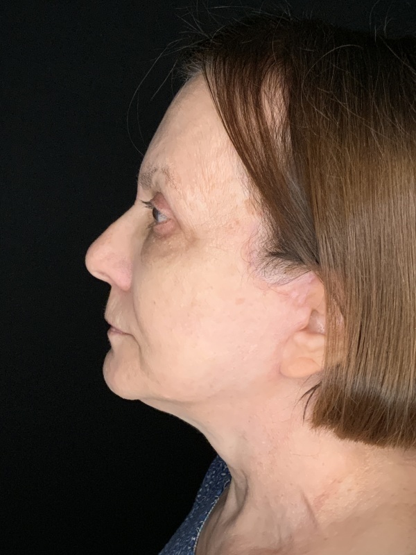 Patient #36954: In-Office Facelift with Fat Injections and Upper Blepharoplasty After Image