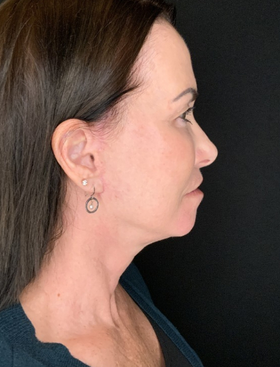 Patient #12585: In-office facelift with Fat Injections, Lip Lift & Perioral Ablative Laser After Image