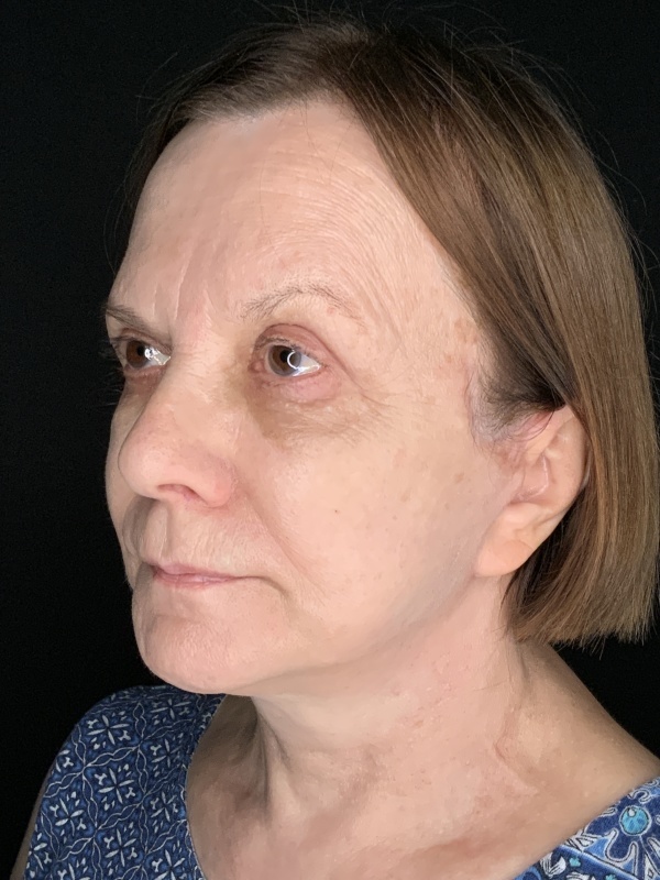 Patient #36954: In-Office Facelift with Fat Injections and Upper Blepharoplasty After Image