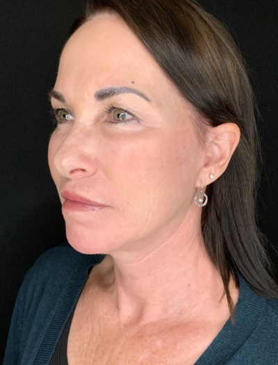 Patient #12585: In-office facelift with Fat Injections, Lip Lift & Perioral Ablative Laser After Image