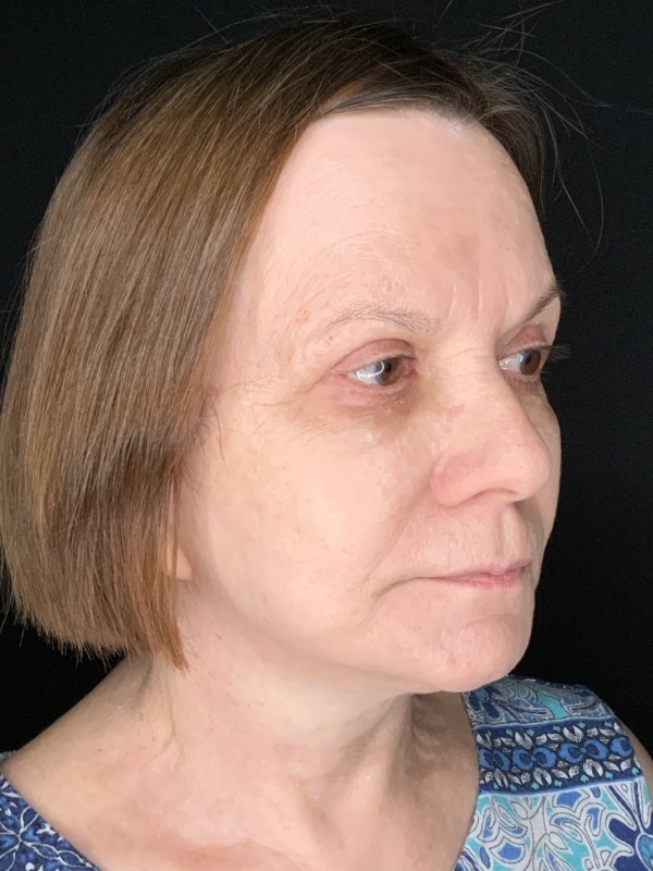 Patient #36954: In-Office Facelift with Fat Injections and Upper Blepharoplasty After Image