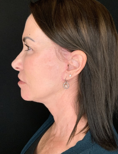 Patient #12585: In-office facelift with Fat Injections, Lip Lift & Perioral Ablative Laser After Image