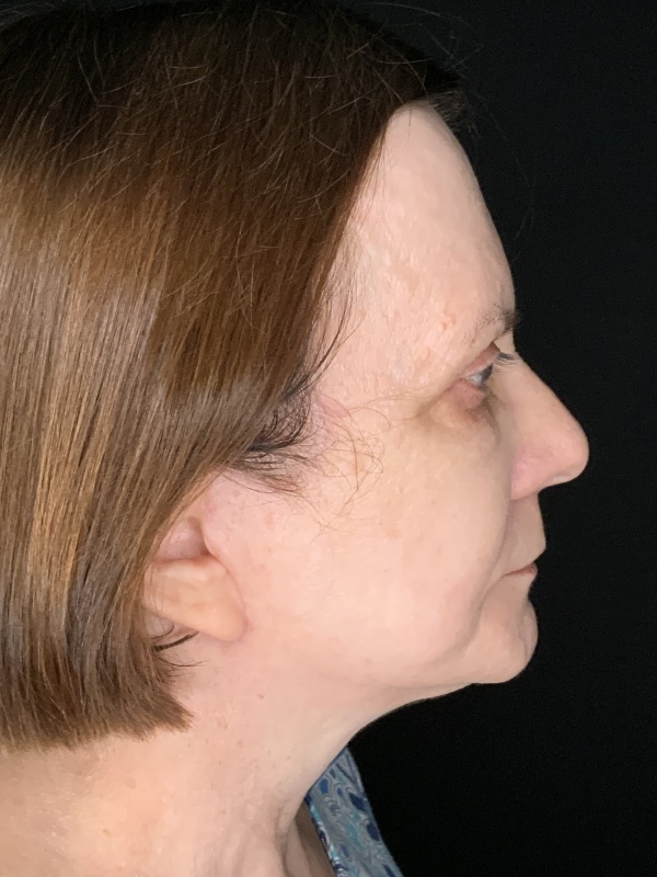 Patient #36954: In-Office Facelift with Fat Injections and Upper Blepharoplasty After Image