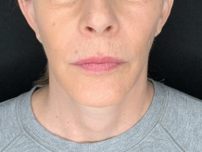 Patient #36789: In-Office Facelift with Fat Injections After Image