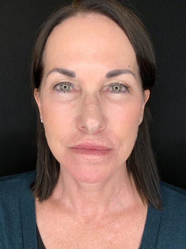 Patient #12585: In-Office Facelift with Fat Injections, Lip Lift, & Perioral Ablative Laser [DUPLICATE] After Image