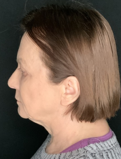 Patient #36954: In-Office Facelift with Fat Injections and Upper Blepharoplasty Before Image