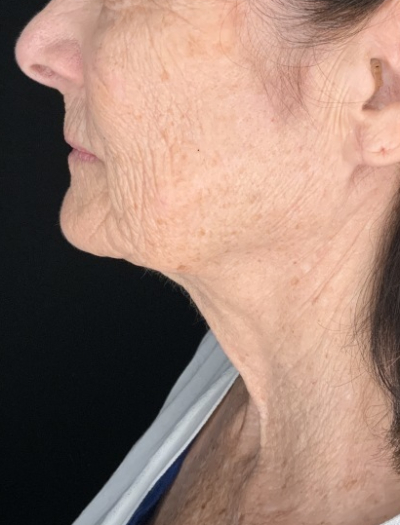 Patient #31258: In-Office Facelift with Fat Injections and Perioral Ablative Laser Before Image