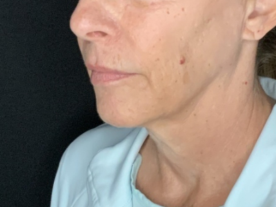 Patient #36789: In-Office Facelift with Fat Injections Before Image