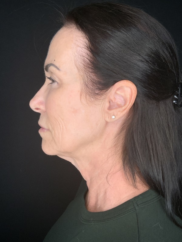 Patient #12585: In-Office Facelift with Fat Injections, Lip Lift, & Perioral Ablative Laser [DUPLICATE] Before Image