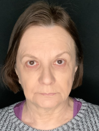 Patient #36954: In-Office Facelift with Fat Injections and Upper Blepharoplasty Before Image