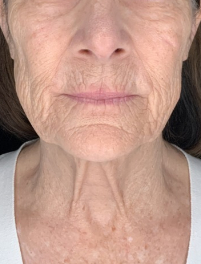 Patient #31258: In-Office Facelift with Fat Injections and Perioral Ablative Laser Before Image