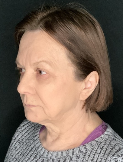 Patient #36954: In-Office Facelift with Fat Injections and Upper Blepharoplasty Before Image