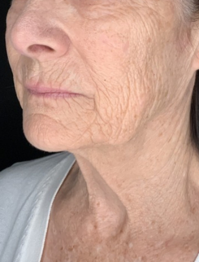 Patient #31258: In-Office Facelift with Fat Injections and Perioral Ablative Laser Before Image