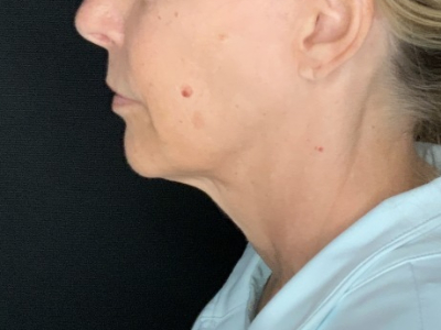 Patient #36789: In-Office Facelift with Fat Injections Before Image