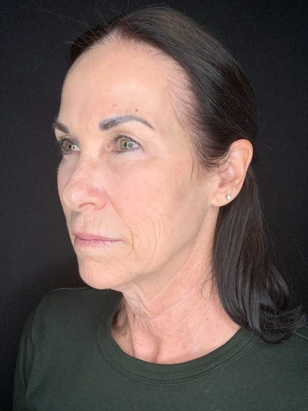 Patient #12585: In-Office Facelift with Fat Injections, Lip Lift, & Perioral Ablative Laser [DUPLICATE] Before Image