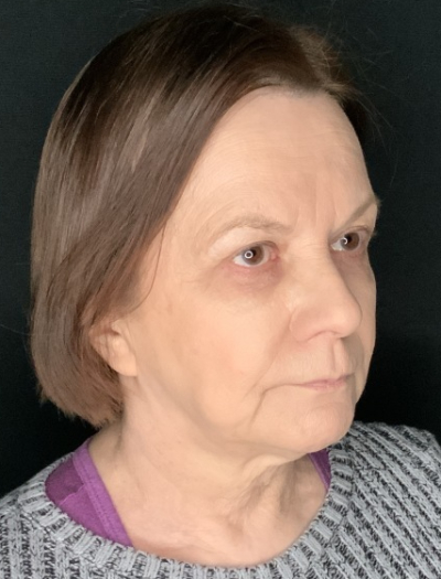 Patient #36954: In-Office Facelift with Fat Injections and Upper Blepharoplasty Before Image