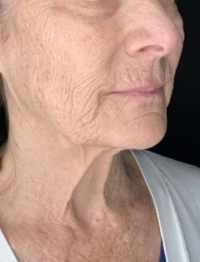 Patient #31258: In-Office Facelift with Fat Injections and Perioral Ablative Laser Before Image