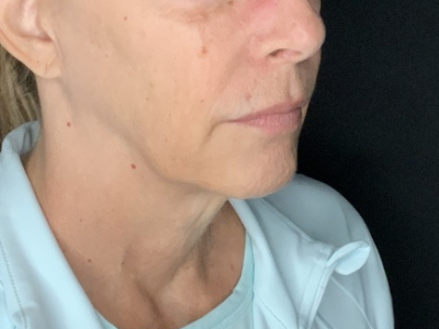 Patient #36789: In-Office Facelift with Fat Injections Before Image