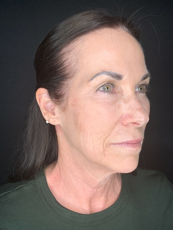 Patient #12585: In-Office Facelift with Fat Injections, Lip Lift, & Perioral Ablative Laser [DUPLICATE] Before Image