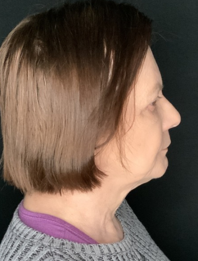 Patient #36954: In-Office Facelift with Fat Injections and Upper Blepharoplasty Before Image