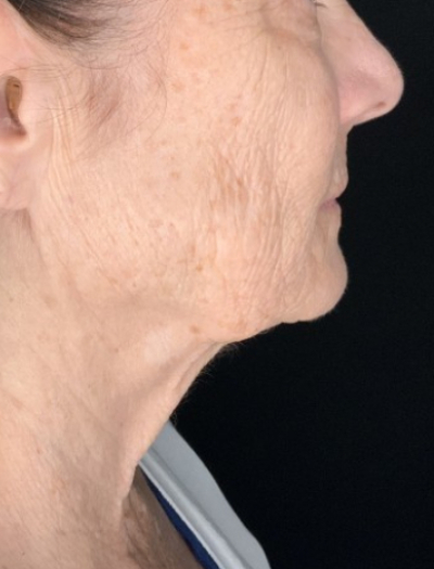 Patient #31258: In-Office Facelift with Fat Injections and Perioral Ablative Laser Before Image