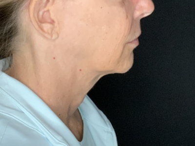 Patient #36789: In-Office Facelift with Fat Injections Before Image