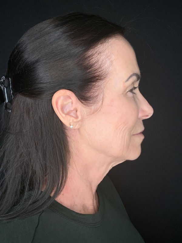 Patient #12585: In-Office Facelift with Fat Injections, Lip Lift, & Perioral Ablative Laser [DUPLICATE] Before Image