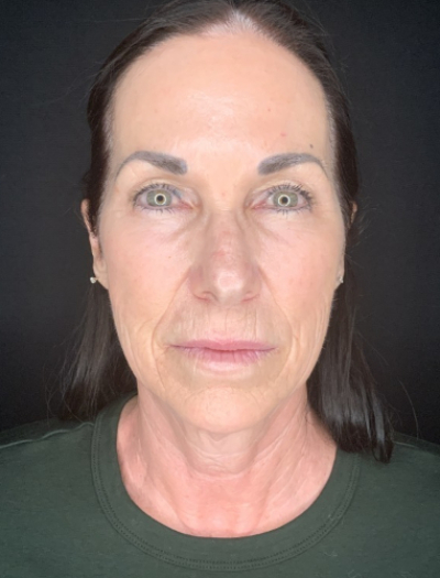 Patient #12585: In-office facelift with Fat Injections, Lip Lift & Perioral Ablative Laser Before Image