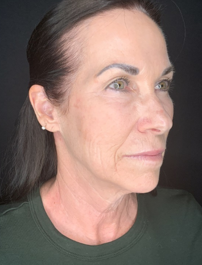 Patient #12585: In-office facelift with Fat Injections, Lip Lift & Perioral Ablative Laser Before Image