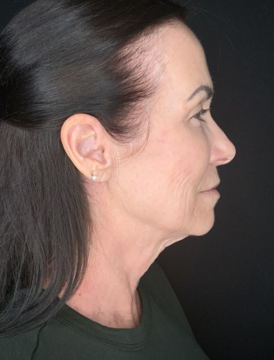 Patient #12585: In-office facelift with Fat Injections, Lip Lift & Perioral Ablative Laser Before Image